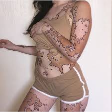 ترمیم ویتیلیگو پیسی برص